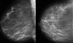 Mamografi ve diğer meme için yapılan görüntülemelerde geçen BİRADS sınıflaması nedir ?