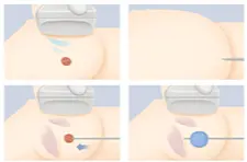 Meme Kanserinde Kriyoablasyon Nedir ve Kimlere Yapılabilir ?