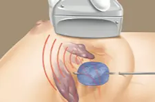 Meme Kanserinin Lokal Tedavisinde Kriyoablasyon Tedavisinin Cerrahiye Üstünlüğü Var Mıdır?