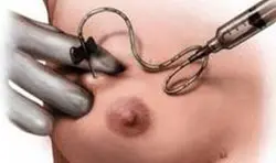 Kist aspirasyonu nedir? Niçin ve nasıl yapılır?