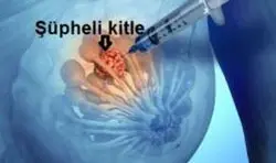 Meme biyopsisi niçin nasıl yapılır?